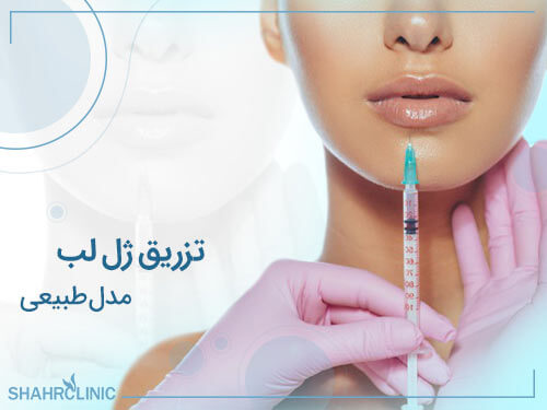 تزریق ژل لب مدل طبیعی