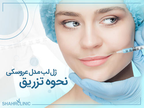 نحوه تزریق ژل لب مدل عروسکی