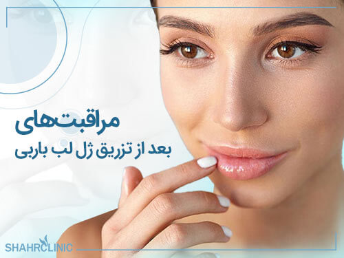 مراقبت‌های بعد از تزریق ژل لب باربی