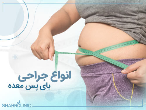 انواع جراحی بای پس معده