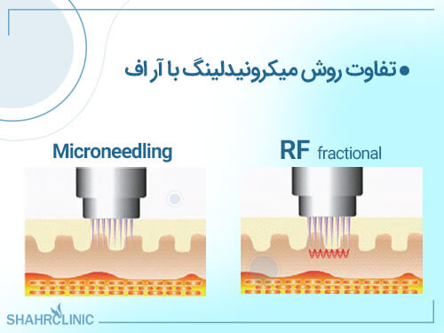 تفاوت روش میکرونیدلینگ با آر اف