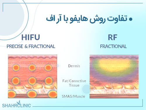 تفاوت روش هایفو با آر اف
