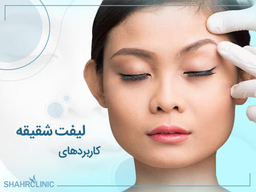 کاربردهای لیفت شقیقه