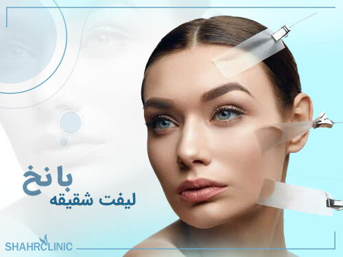 لیفت شقیقه با نخ