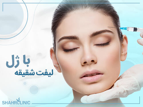 لیفت شقیقه با ژل