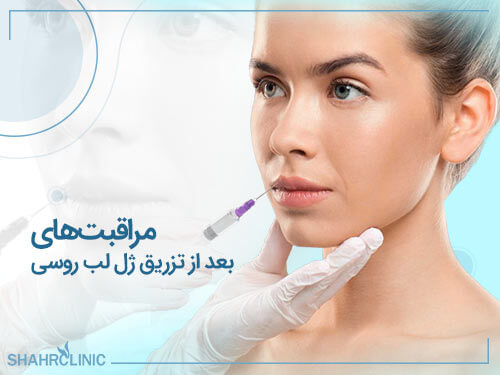 مراقبت‌های بعد از تزریق ژل لب روسی