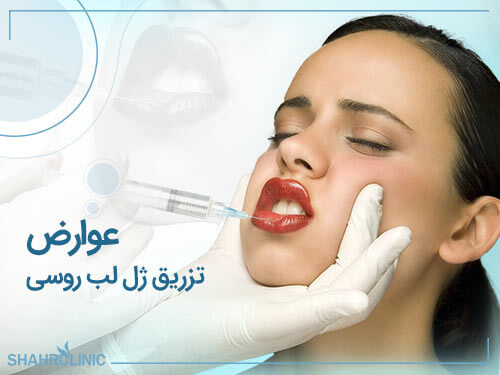 عوارض تزریق ژل لب روسی