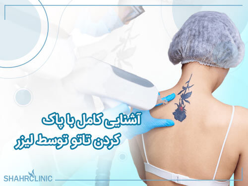 آشنایی کامل با پاک کردن تاتو با لیزر