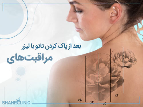 مراقبت‌های بعد از پاک کردن تاتو با لیزر