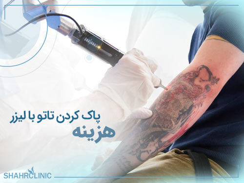 هزینه پاک کردن تاتو با لیزر