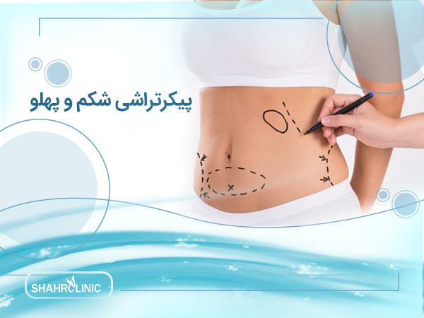 پیکر تراشی شکم و پهلو