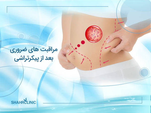 مراقبت های ضروری پس از عمل پیکر تراشی