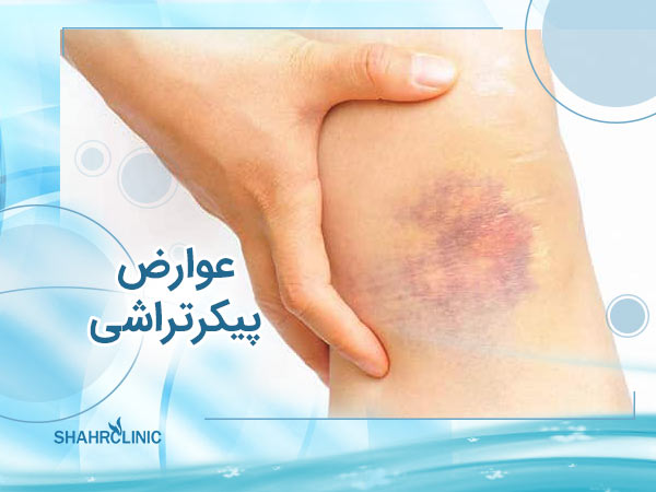 عوارض پیکر تراشی