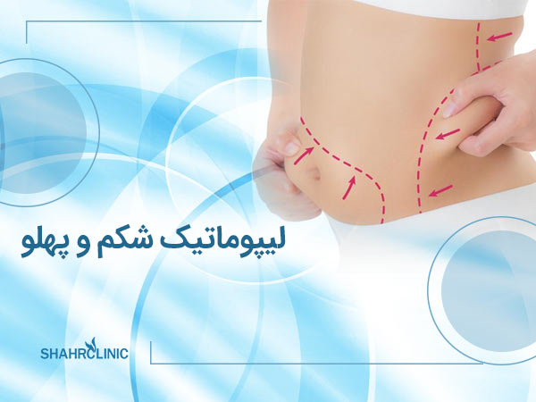 لیپوماتیک شکم و پهلو