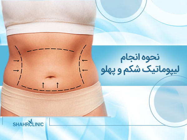 نحوه ی انجام لیپوماتیک