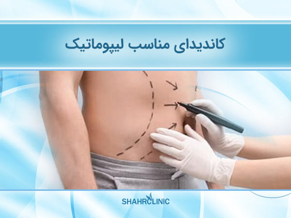کاندیدای مناسب لیپوماتیک شکم و پهلو