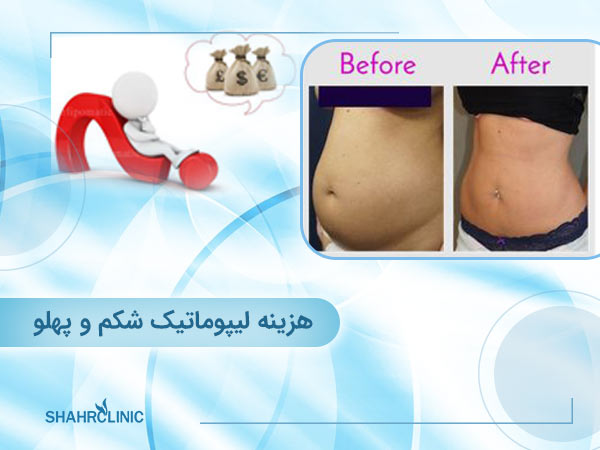 هزینه لیپوماتیک شکم و پهلو