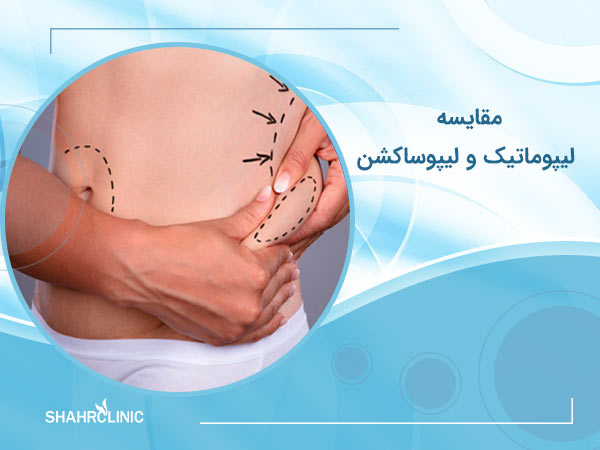مقایسه لیپوماتیک و لیپوساکشن