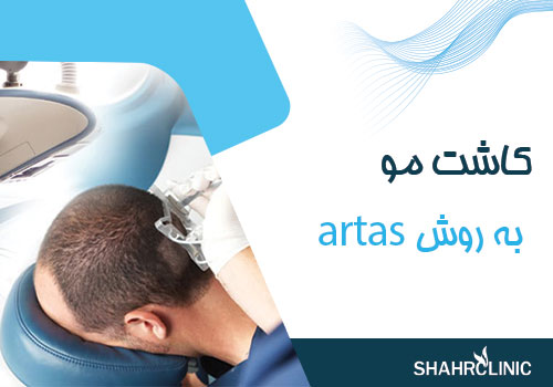 کاشت مو به روش artas