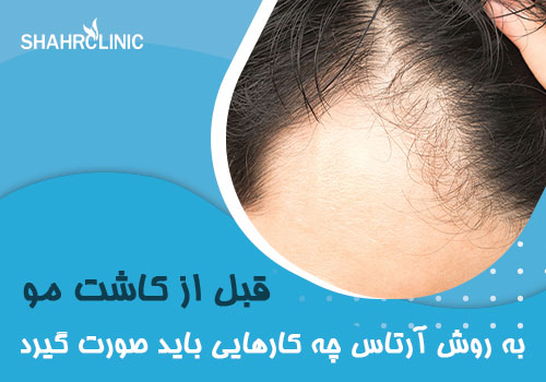 قبل از کاشت مو به روش artist چه ‌کارهایی  باید صورت گیرد؟