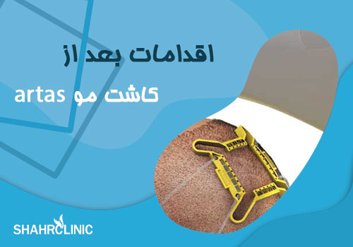 چه اقداماتی باید پس از کاشت مو به روش آرتاس انجام دهید؟