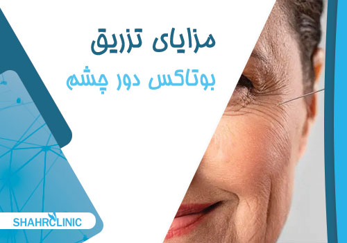 مزایای تزریق بوتاکس دور چشم