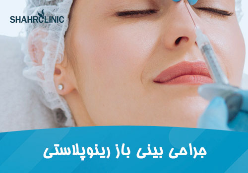 جراحی بینی باز رینوپلاستی