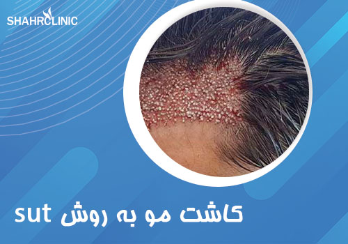 کاشت مو به روش SUT