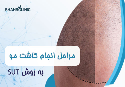 مراحل انجام کاشت مو به روش SUT
