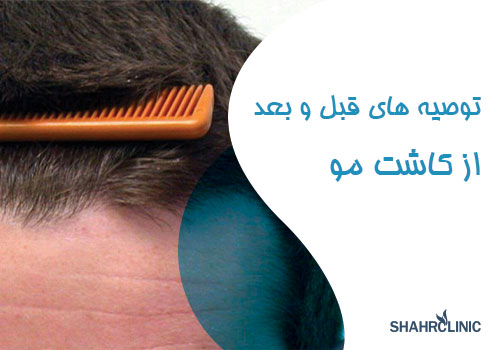 توصیه های قبل و بعد از کاشت مو