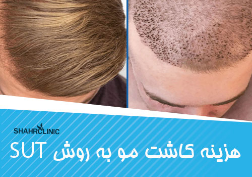 هزینه ی کاشت مو به شیوه SUT
