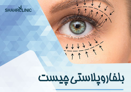 بلفاپلایتی