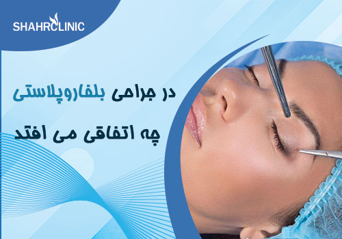 در جلسه بلفاروپلاستی چه اتفاقاتی می افتد؟