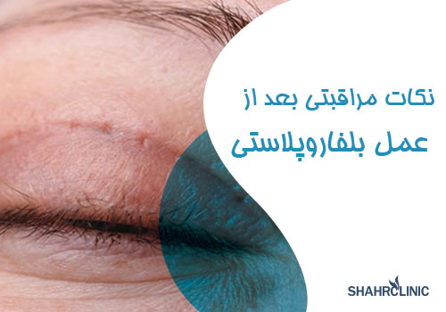 نکات مراقبتی در منزل بعد از انجام جراحی بلفاروپلاستی