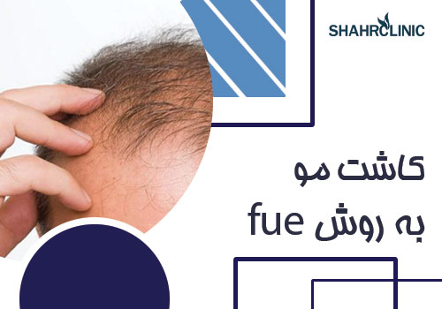 آشنایی با روش کاشت مو به روش FUE