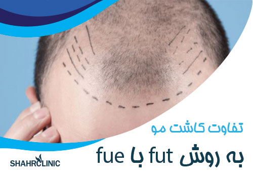تفاوت کاشت مو به روش FUE و FUT