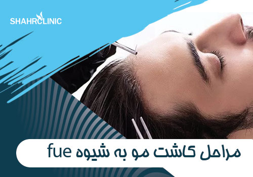 از مراحل کاشت مو به روش FUE چه می دانید؟