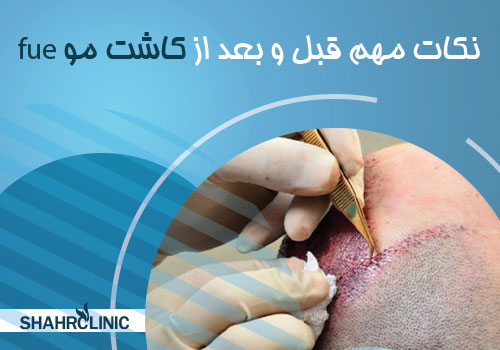 نکات مهم قبل از انجام کاشت مو  FUE