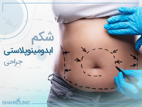 جراحی ابدومینوپلاستی شکم
