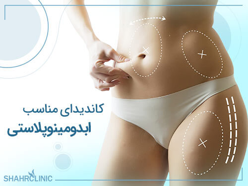 کاندیدای مناسب برای عمل ابدومینوپلاستی چه کسانی هستند