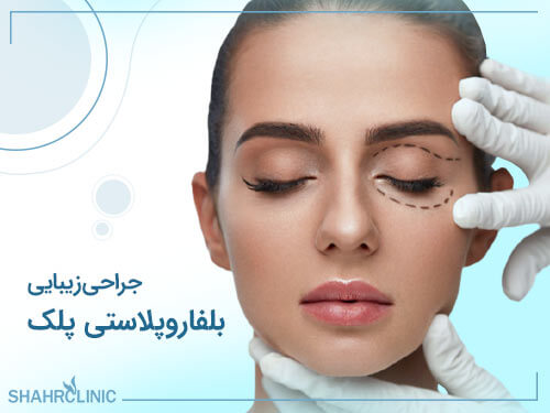 جراحی زیبایی بلفاروپلاستی پلک