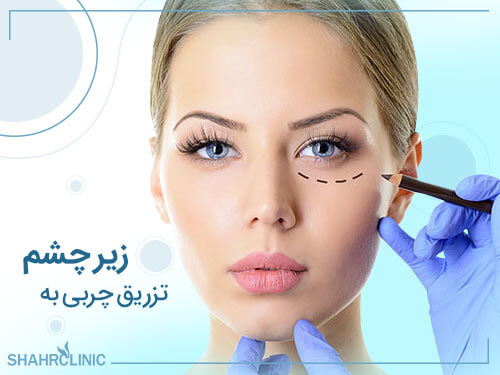 تزریق چربی زیر چشم