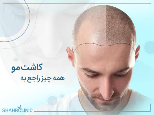 همه چیز راجع به کاشت مو