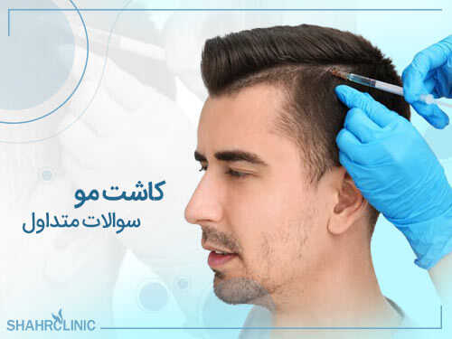 سوالات متداول کاشت مو