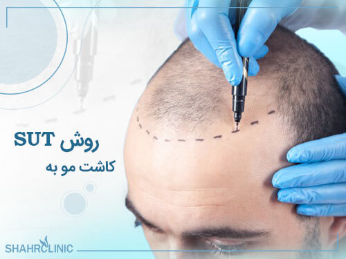 کاشت مو به روش sut