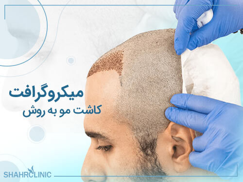 کاشت مو به روش میکروگرافت