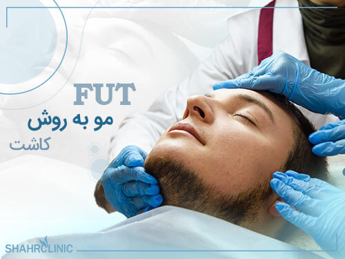 کاشت مو به روش fut