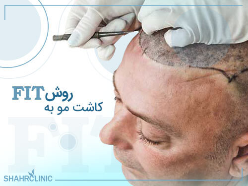 کاشت مو به روش fit