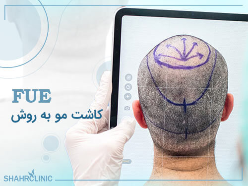 کاشت مو به روش FUE