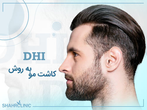 کاشت مو به روش dhi